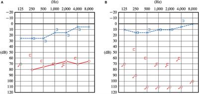 Perilymphatic fistula with characteristic findings of the inner ear by contrast-enhanced magnetic resonance imaging: a case report